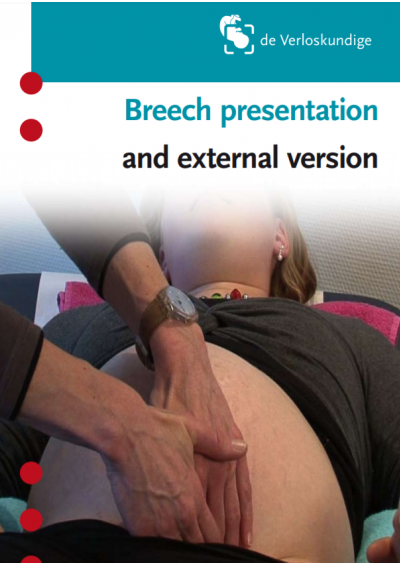 Uitwendige versie en stuitligging Engels